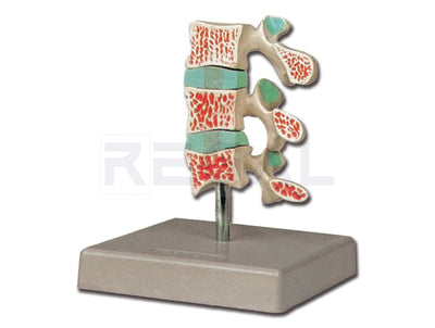 ADVANCED OSTEOPOROSIS